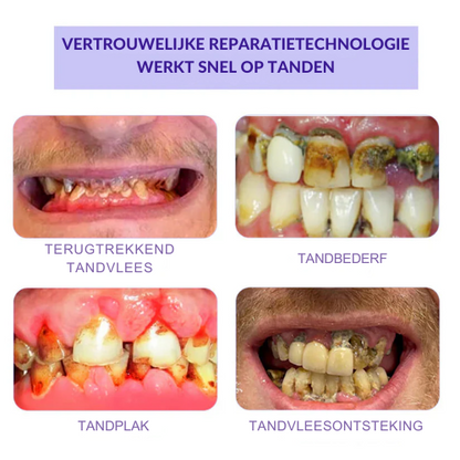 (🔥Last Day Promotion - 50% Off)  | Tanden Restauratie Mineraal Poeder