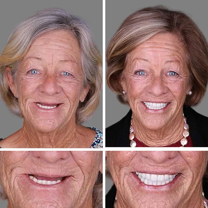 Denture Smile Transformation